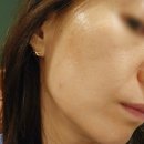 영등포구 여의도 유스피부과에서 모공축소 위해 모공레이저 '아토스' 받아본 후기