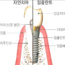 여러가지 임플란트 종류~~ 이미지