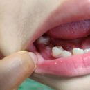 삼성온가족치과의원 | 초등학생 잇몸에 혹처럼 생긴 염증/원인/ 치료후기(세종 삼성온가족치과)