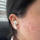 메트로피부과의원 | [정발산]톤즈의원 아그네스 시술후기 내돈내산