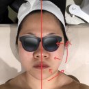 오브이메디컬 | 부산 부산진구 전포동 서면피부관리 가봄 더라인 울트라갸름젯 후기