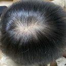 재정한의원 | [20대 탈모녀] 한의원 탈모 치료 후기(진행중~)