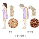 골다공증, 뼈가 보내는 신호를 놓치지 마세요 | 케이튼튼정형외과 오치헌 원장