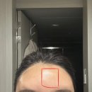 하나중앙의원 | 김해 밴스의원 | 이마필러 잘하는 피부과 추천 내돈내산 솔직후기 (전,후 사진)