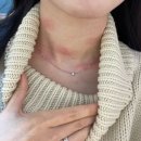 선명한의원 | 강서 가양 한의원에서 거우침 치료로 편평사마귀 제거한 후기 (듀오덤 no, 당일세안 ok)