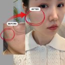 옆볼 꺼짐 해결? 쥬베룩볼륨 후기 7일차, 부작용 걱정 없는 강남역피부과 방문기