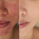 정선생 | [정선생전문스킨케어] 지루성피부염, 주사피부염이 있던 피부의 현재 상태입니다