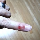 동성환경 | 상처에 슥 바르면 끝!동성제약 프리덤폼겔 5ml 사용 후기