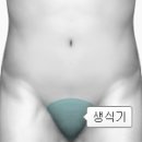 바르톨린샘의 고름집(Abscess of Bartholin's gland)여성질환 이미지