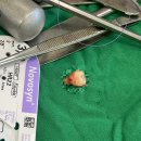 관악서울대학교치과병원 | 관악서울대학교치과병원 사랑니 발치 후기(통증, 붓기, 비용 등)