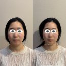 리샘한의원 일산점에서 비대칭교정 받은 후기