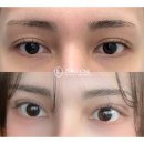 제로원성형외과의원 | 꺼진 눈밑 때문에 내가 추구하는 인상이 아닐 때? 눈밑지방재배치+눈두덩이 지방이식으로 인상 개선된 후기