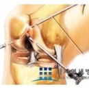 가좌역십자인대파열 관절내시경수술치료정보 [가자연세병원] 이미지