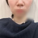 자동차피부과 | 홍대 피부과 팔자주름 고민 홍대 쥬베룩 솔직 후기