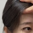 (주)자연과 사람들 | 자연유착 + 윗트임 후기 // 내돈내산 쌍수후기 / 부작용 / 매몰 쌍커풀 수술 후기