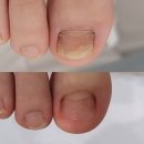 천안 내성발톱 관리 잘하는 레푸스 천안두정점 꼼꼼한 발케어 후기