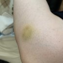 왼발 척골 금 간 후기