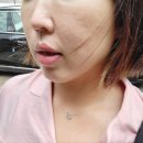 클로엔의원 | 성인여드름피부과 패인흉터 모공 피부결 진심후기
