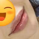 울산 피부과 입술 필러 잘하는 곳 + 엑셀V, 아쿠아필 받고 온 후기 🙋‍♀️