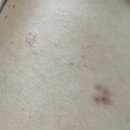 어수동피부과의원 네이버블로그
