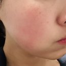 더블유의원 | 강남역 · 신논현역 더블유의원 볼뉴머 리프팅 솔직후기💆‍♀️✨