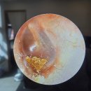 하늘이비인후과의원 | 귀에서 바스락 소리? 이비인후과에서 고막 귀지 제거한 후기