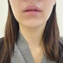신사역 지방분해주사 의원 2회차 리얼 후기! 상상하던 턱라인이 보여요!