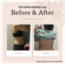 순환로4L | [진주 다이어트] D-1. 신부 웨딩관리 지방분해주사로 드레스 라인 정리한 솔직한 후기