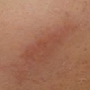 보니따의원 | 보니따의원에서 흉터치료 받은 후기