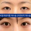 아이케이성형외과의원 네이버블로그