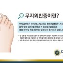 [대찬병원] 슬리퍼&amp; 샌들의 계절인 여름, 휘어진 엄지발가락 증상 - 무지외반증에 대해! 이미지