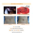 담낭선근종수술후기. 누가 쓸개 얘기하면 저는 무조건 튼튼병원 김정윤 원장님께 가라고 무조건 추천하겠습니다. 이미지