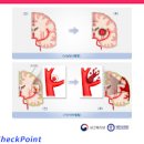 (뇌졸중) 뇌경색 원인 및 방법 이미지