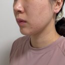 고려탑석미의원 | 용인 동안미인의원 쿨페이즈 600샷 내돈내산 후기(통증,다운타임,관리주기,지속기간)