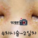 아그네스 - 음성군 | 한관종 아그네스 4차시술 후기 내돈내산