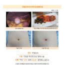 단일담석3cm수술후기. 극심한 우상복부 통증 및 오한, 식은땀등으로 첫 증상이 나타났으나 그 당시에는 단순 체함으로 생각... 이미지