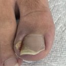 펄스캠 생활과학 영등포 | 영등포내성발톱 아들 반복되는 육아종 아픈발 관리 오벨리네일푸스 족보있는그녀들 금천점