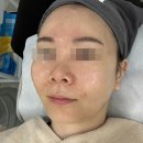 대구 수성구 문제성 피부관리, 여드름 흉터 해결 전문 (+후기사진) : 제이와이뷰티