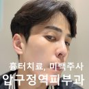 압구정역피부과 여드름 자국 색소침착 치료, 미백주사, 제네시스 레이저 효과 내돈내산 후기.