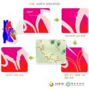 심내막염[endocarditis , 心內膜炎] 이미지