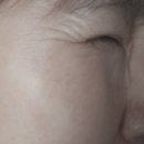 라벨의원 | 인천 서구 보톡스 내돈내산 후기: 마취 없이 아이스팩으로 미간/이마/눈가 도전!