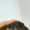 이*자 - 미추홀구 매소홀로 68 | 남자 M자 모발이식 후기 ① 수술 당일 기록