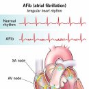부정맥 lone atrial fibrillation을 치료가능한데... 구체적인 기전, 치료법 최신논문!! 이미지
