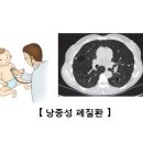 낭종성 폐질환(Cystic Lung Disease)호흡기 질환이란? 이미지