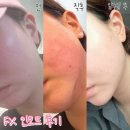 [서면 피부과] 부산 인모드 FX 통증 멍 붓기 술 일주일 경과 솔직 후기