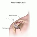 shoulder separation 이미지