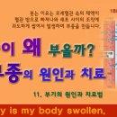 왜 몸이 붓는 걸까? 원인에 따른 치료법 이미지