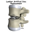 퇴행성 디스크(degeneration of intervertebral disc) - 척추증(spondylosis) 이미지