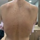 (주)미강 | 리유한의원 강남본점에서 미강약침 받고 등드름 색소침착 없앤 후기