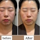 대구윤곽관리 포미뷰티센터/ 대구얼굴경락 받고 팔자주름 펴지고 브이라인 된 후기